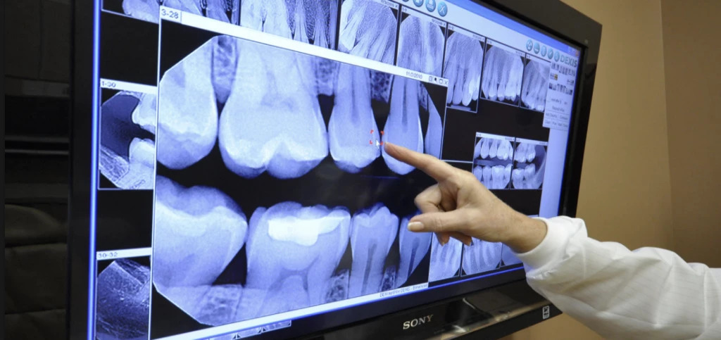 Image of Teeth X-Ray