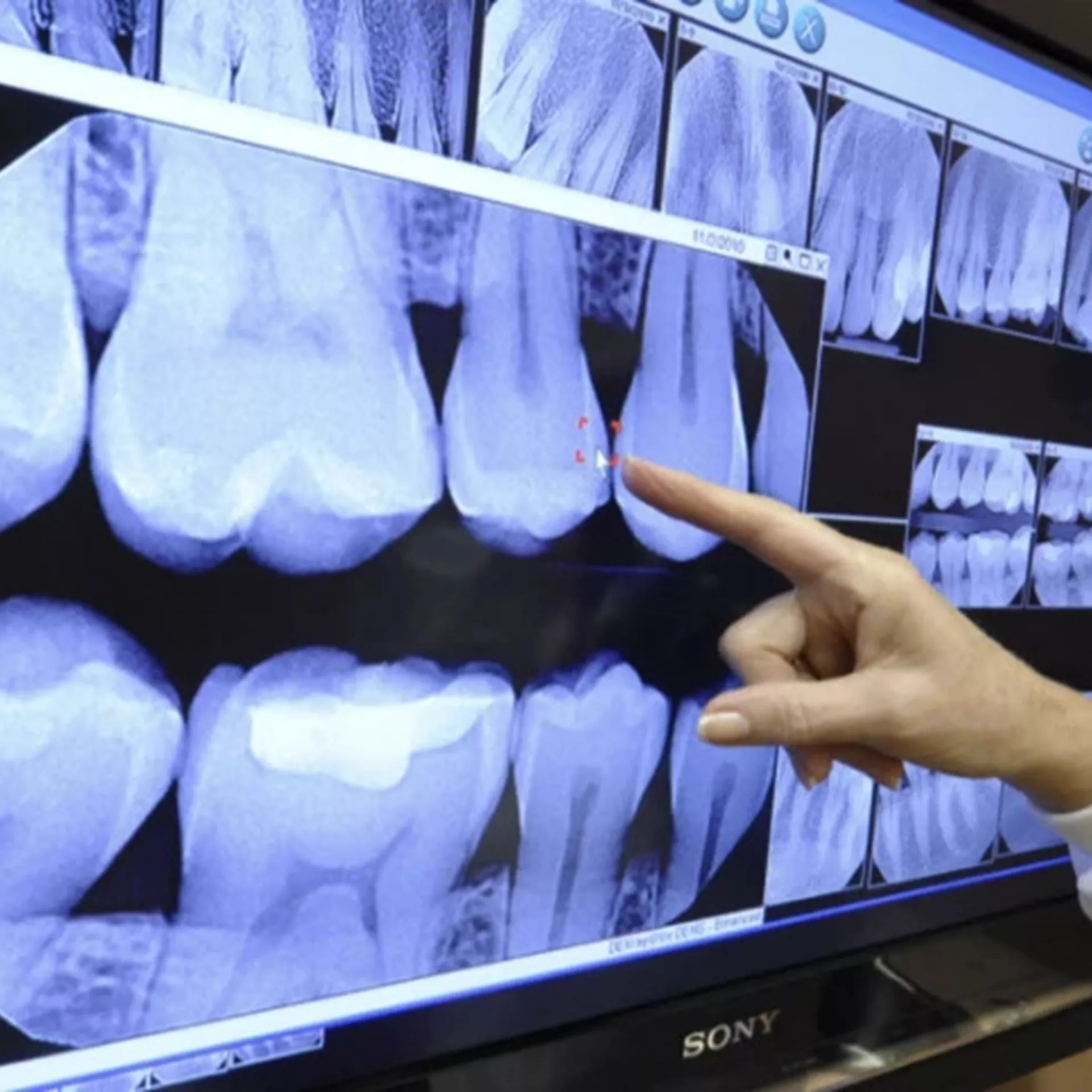 Image of Teeth X-Ray